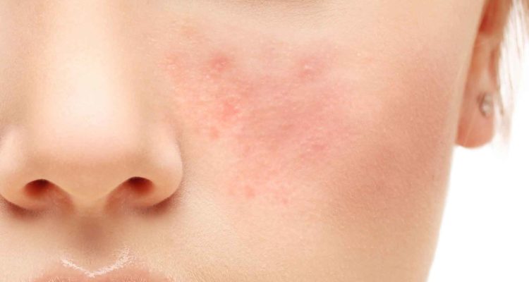 LAS CONSECUENCIAS DE LA ROSÁCEA